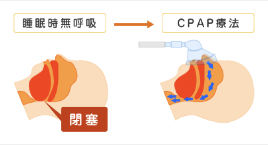 CPAP療法のイラスト図